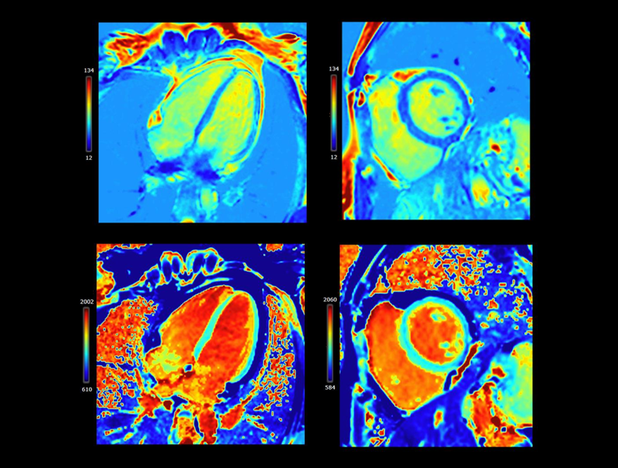 Cardiac Mapping